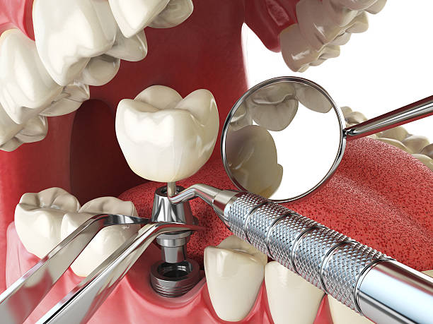 Best Emergency Wisdom Teeth Removal in Franklin, TN